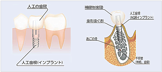 インプラントの構造
