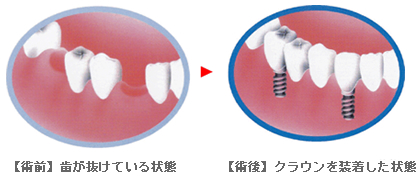 歯が抜けている状態　クラウンを装着した状態