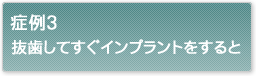 症例3抜歯してすぐインプラントをすると