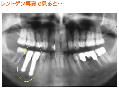 レントゲンで見ると